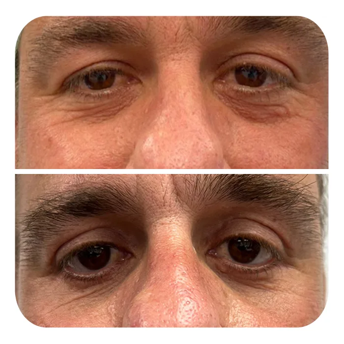 blefaroplastiki_33