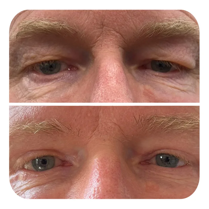 blefaroplastiki_35