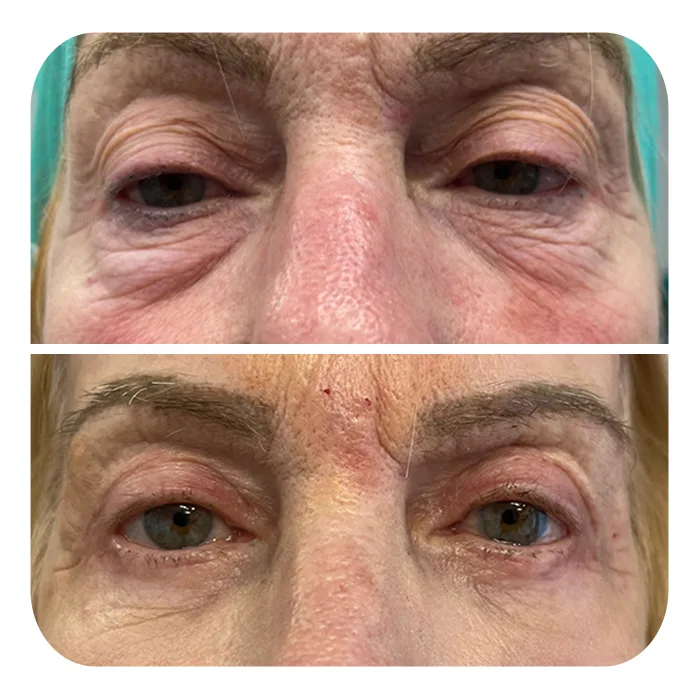 blefaroplastiki_36