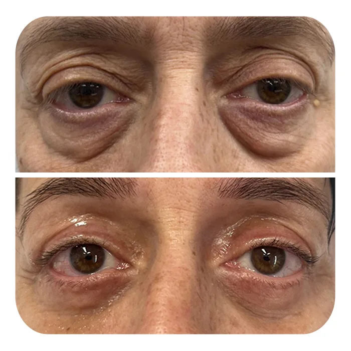 blefaroplastiki_37