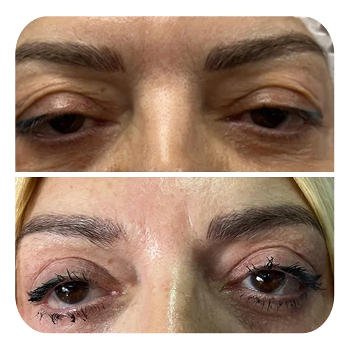 blefaroplastiki_38