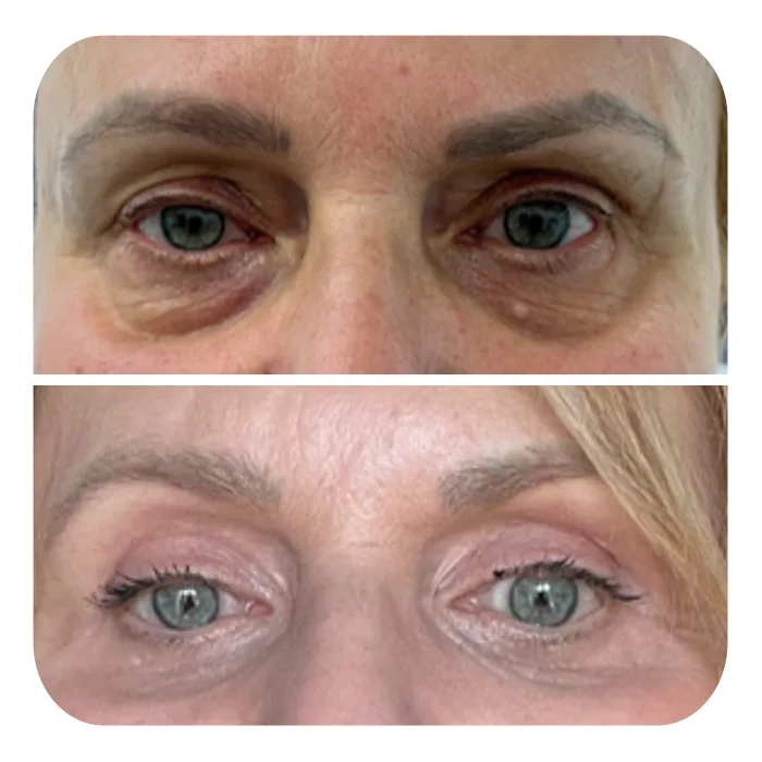blefaroplastiki_39