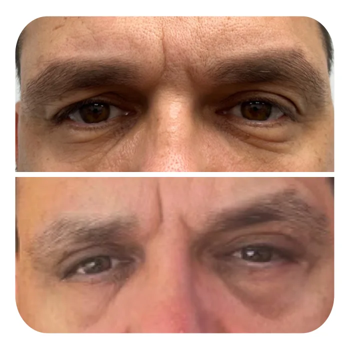 blefaroplastiki_40