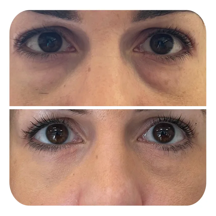 blefaroplastiki_41
