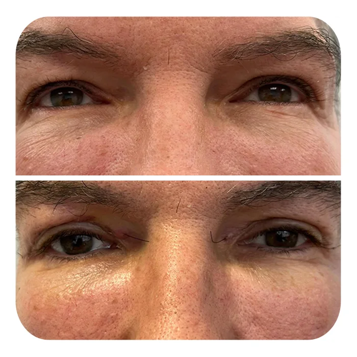 blefaroplastiki_42