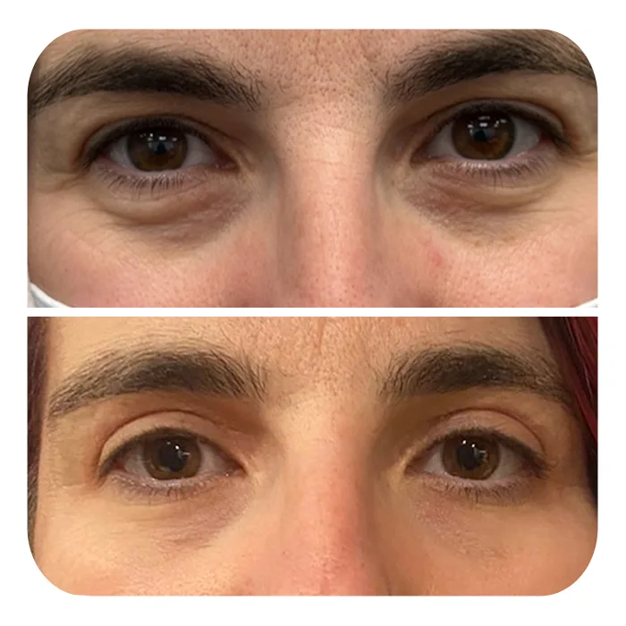 blefaroplastiki_44