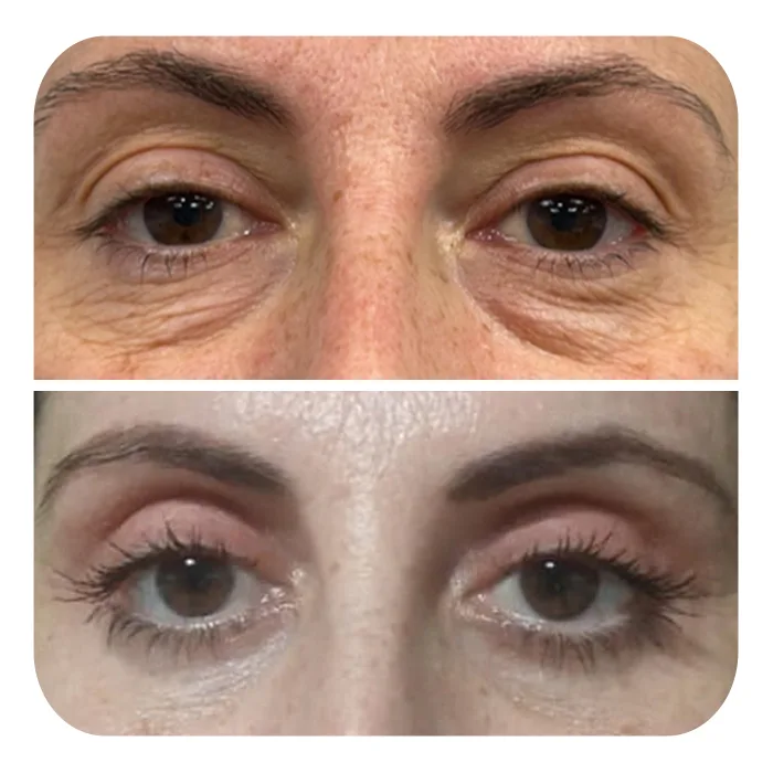 blefaroplastiki_45