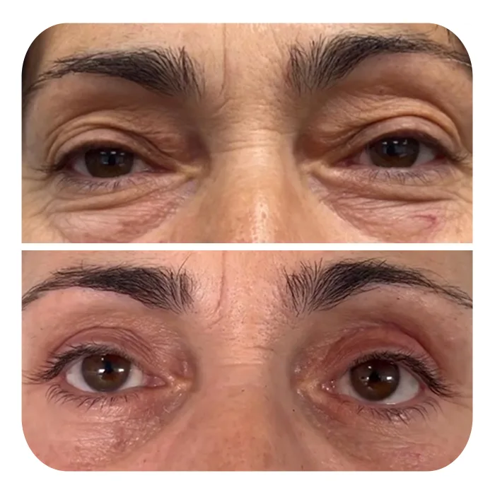 blefaroplastiki_47