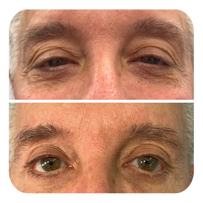 blefaroplastiki_48