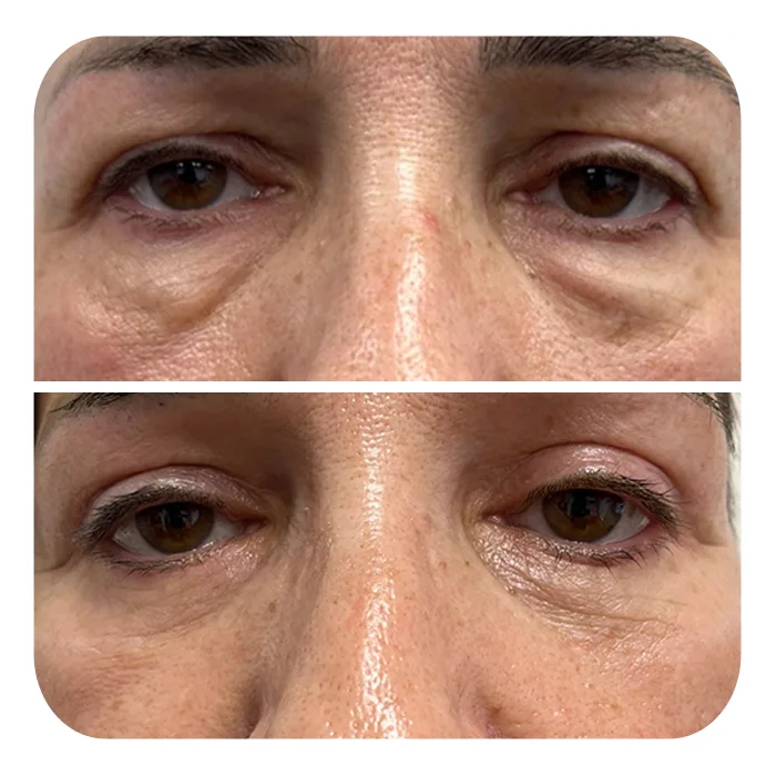 blefaroplastiki_50