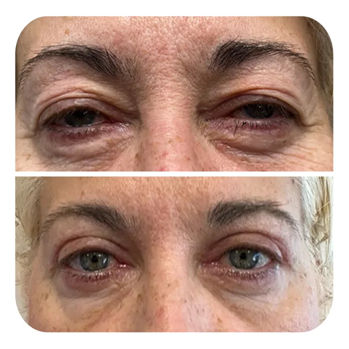 blefaroplastiki_51