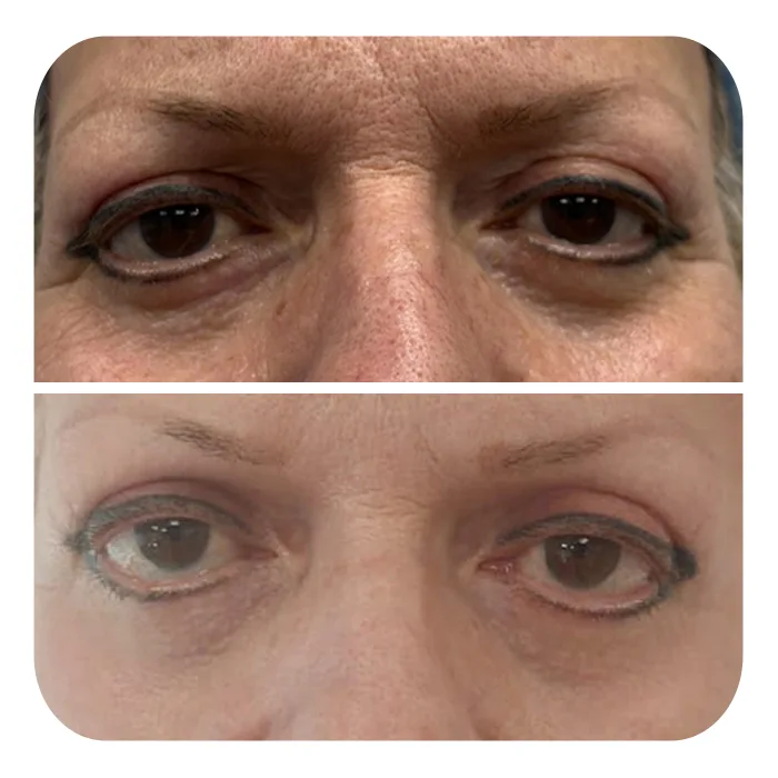 blefaroplastiki_52