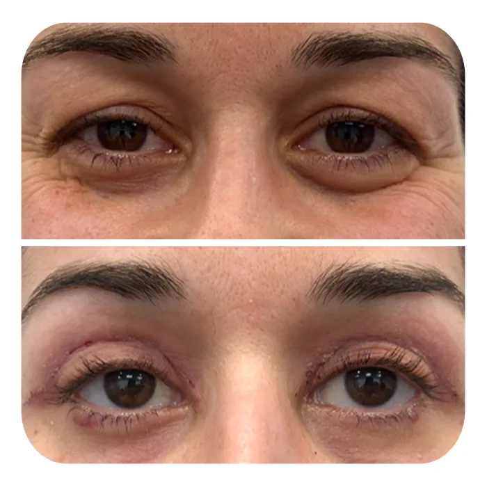 blefaroplastiki_53