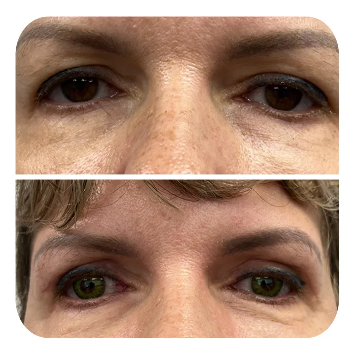 blefaroplastiki_55