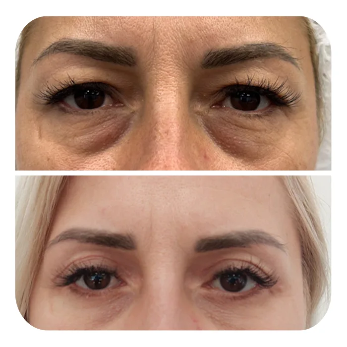 blefaroplastiki_56