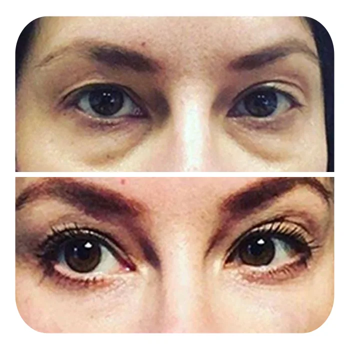 blefaroplastiki_57