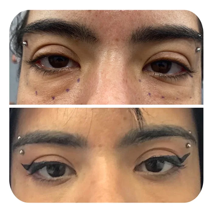 blefaroplastiki_58