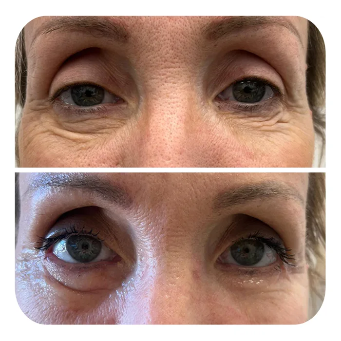 blefaroplastiki_59