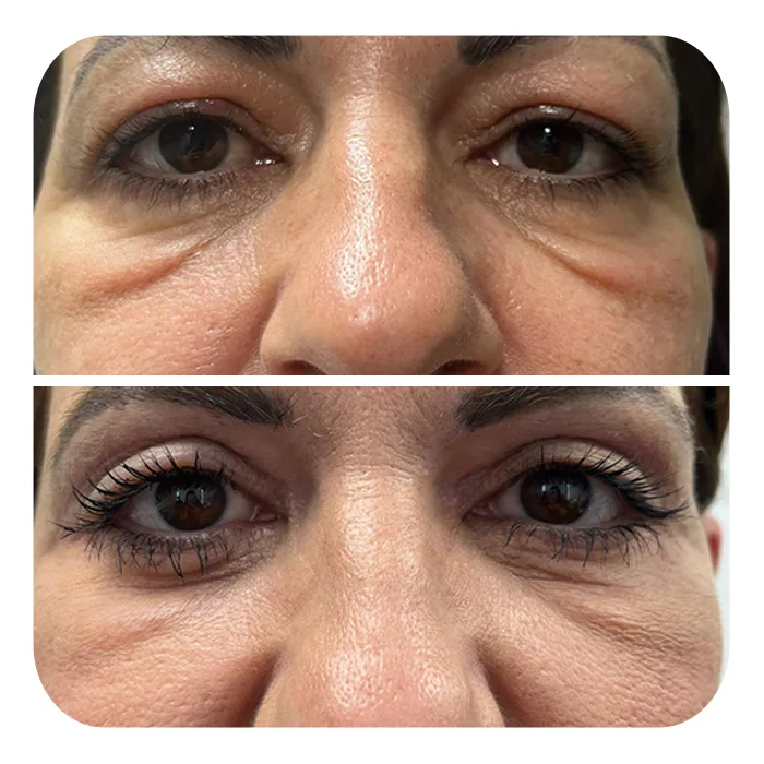 blefaroplastiki_60