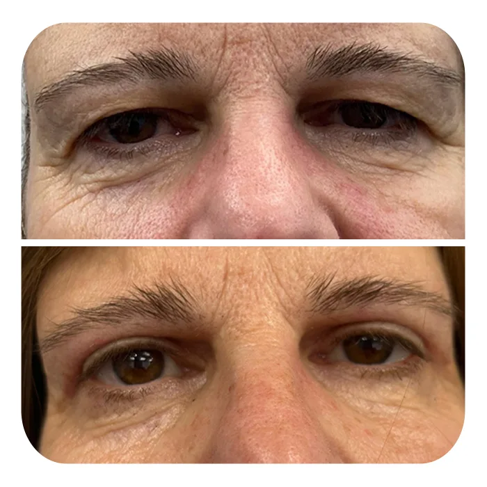 blefaroplastiki_61