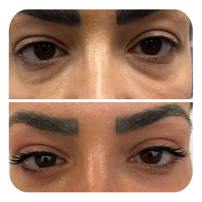 blefaroplastiki_62