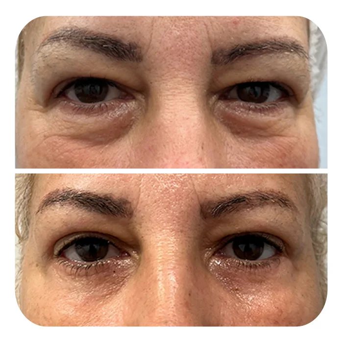 blefaroplastiki_63