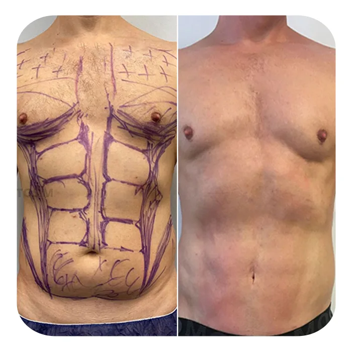 vaser lipo 1