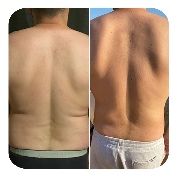 vaser lipo 10