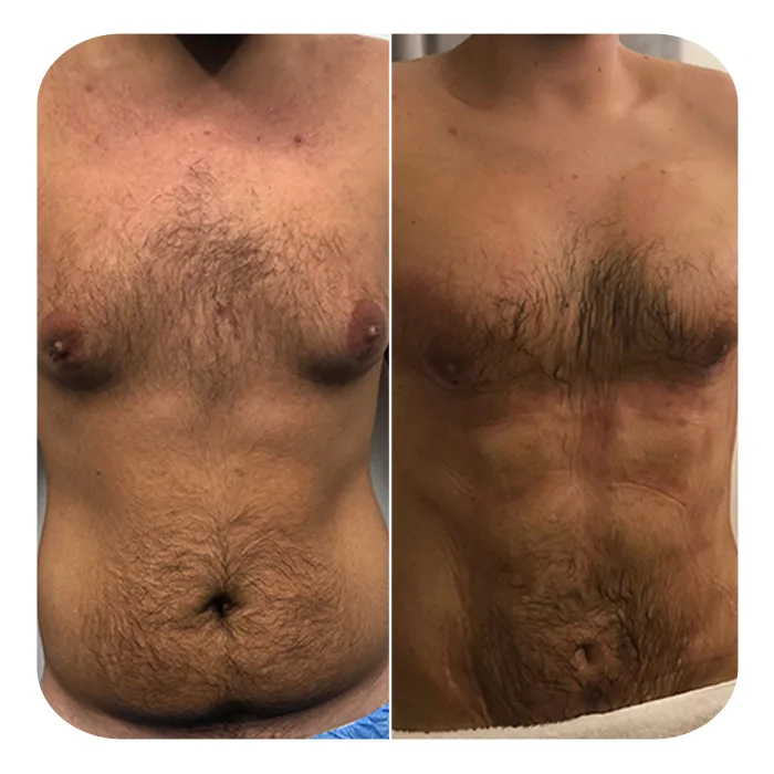 vaser lipo 11