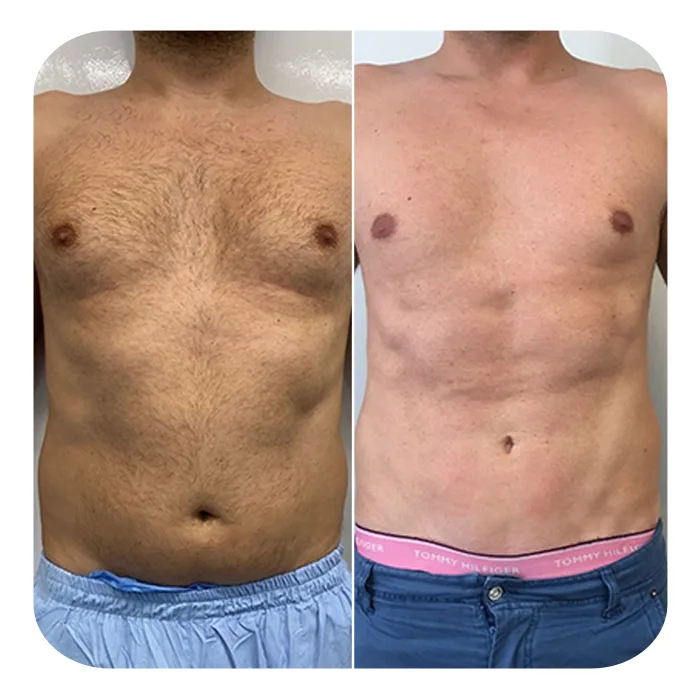 vaser lipo 2