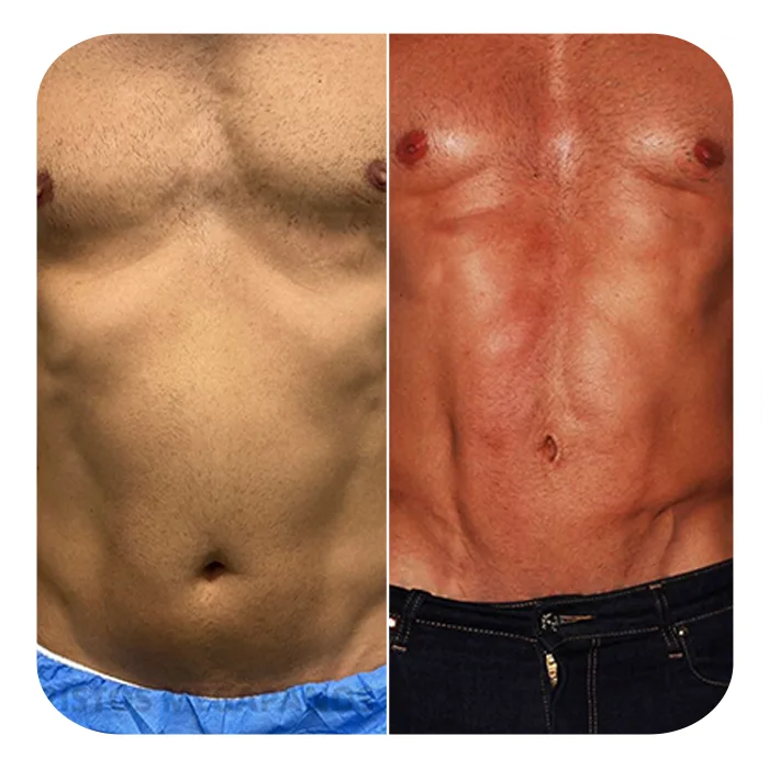 vaser lipo 3