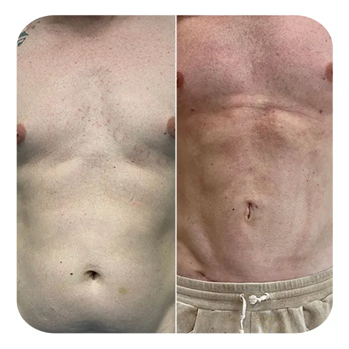 vaser lipo 4
