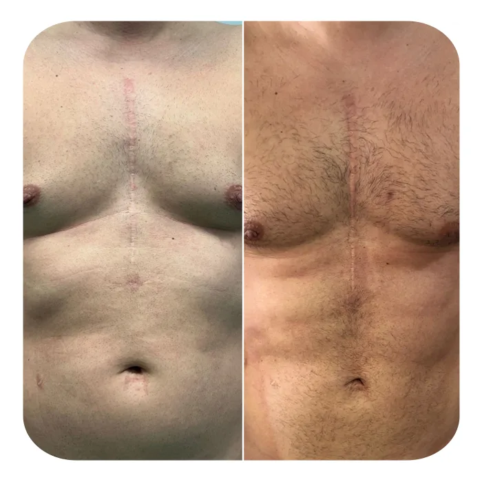 vaser lipo 4d hd 1