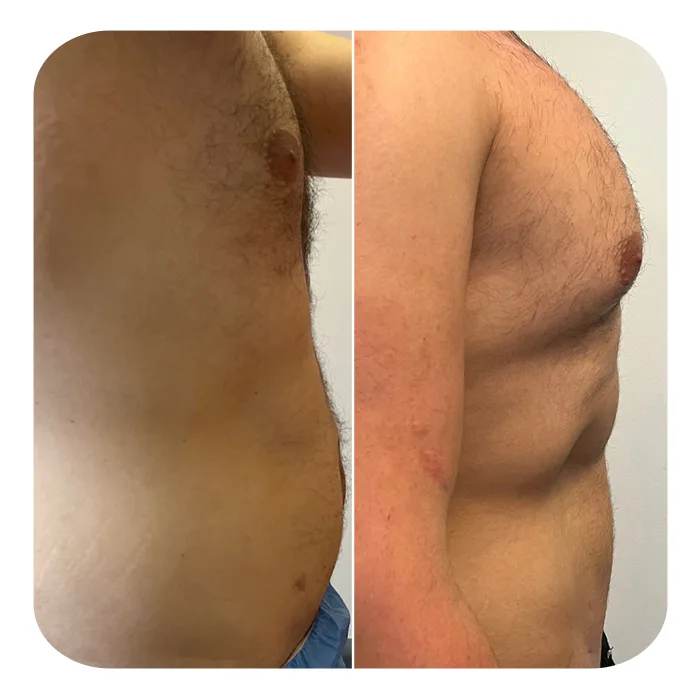 vaser lipo 4d hd 2