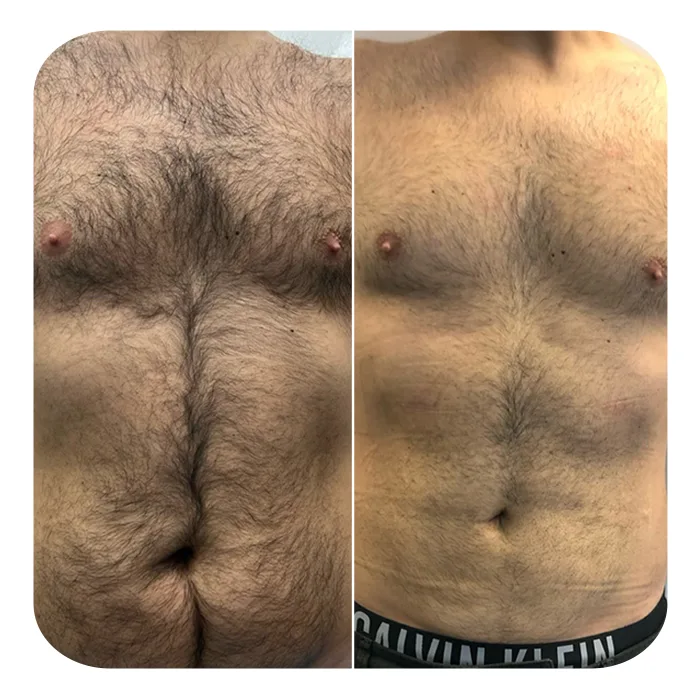 vaser lipo 4d hd 3