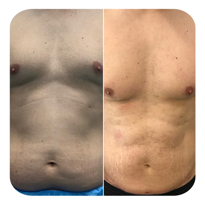 vaser lipo 4d hd 4