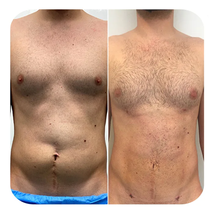 vaser lipo 5