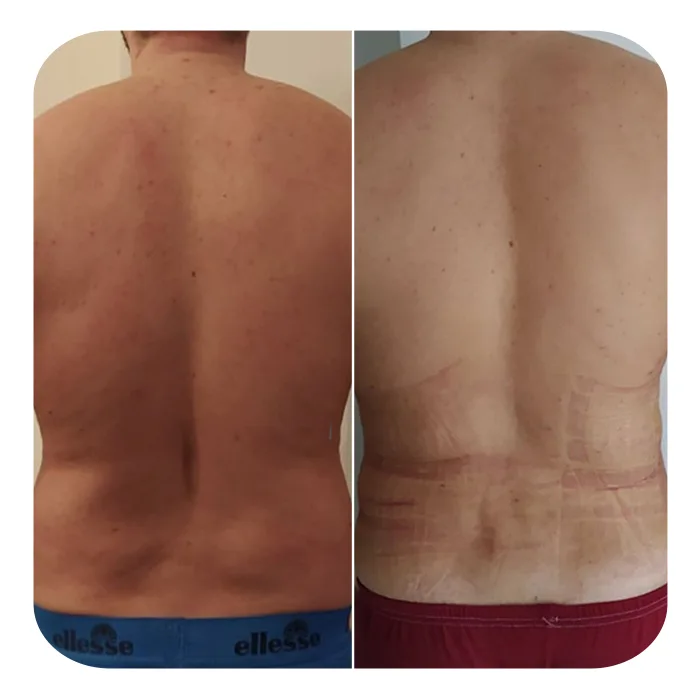 vaser lipo 6