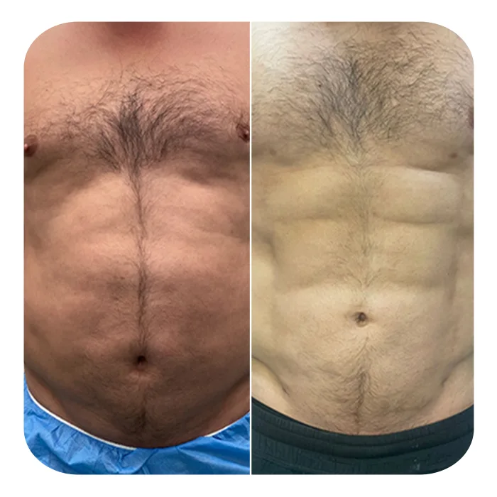 vaser lipo 7