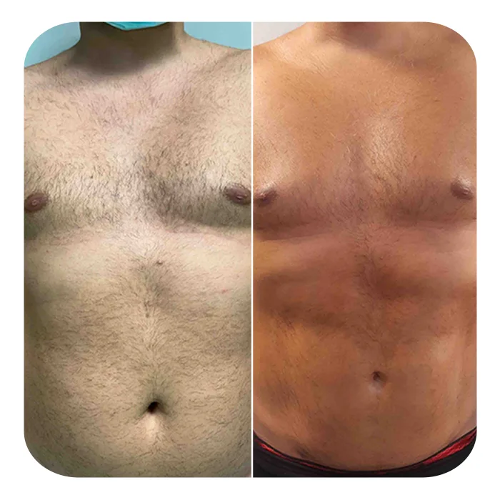 vaser lipo 8
