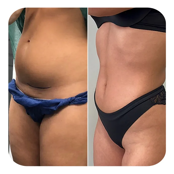 vaser lipo 9